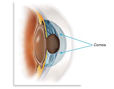 Corneal Transplant