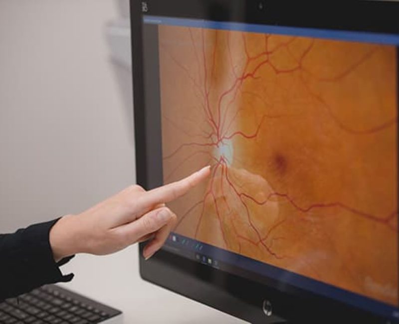 Macular Degeneration treatment at Eye Care Ltd