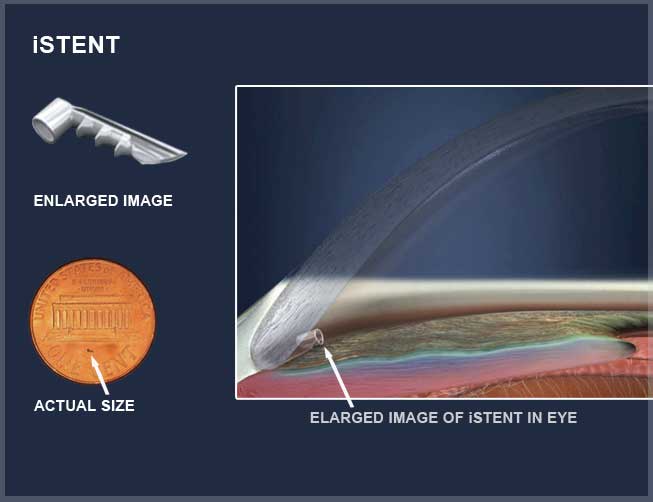 Brett Breshears in a glaucoma specialist in Highland Park and Skokie, IL.