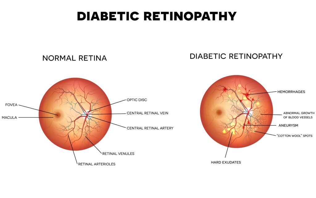 Diabetic Eye Exams in Chicago, Skokie, and Highland Park.
