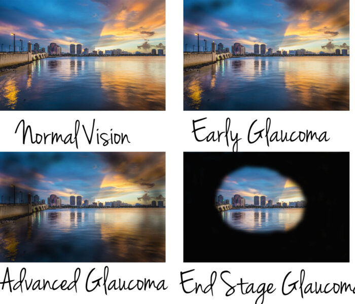 Brett Breshears in a glaucoma specialist in Highland Park and Skokie, IL.